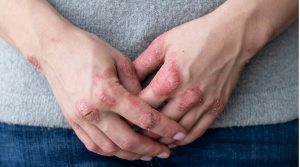 Can Unhealthy Diets Cause Psoriasis
